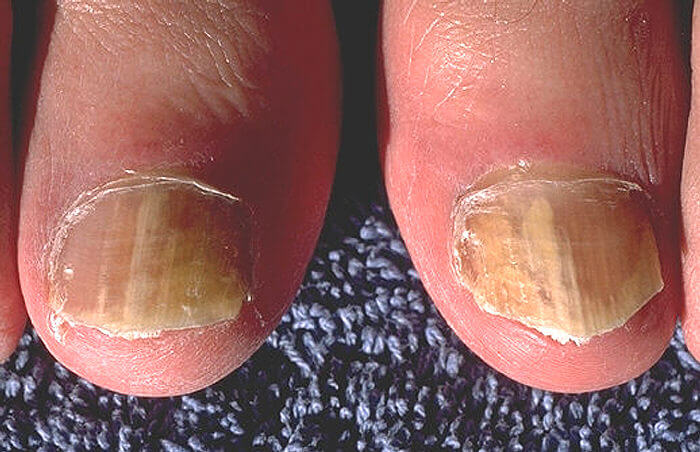 Fungal Nail Infection